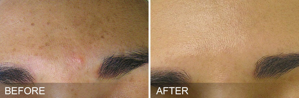 Before and After photos of using Hydrafacial for brown spots