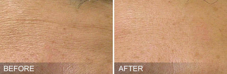 Before and After photos of using Hydrafacial for minimizing fine lines