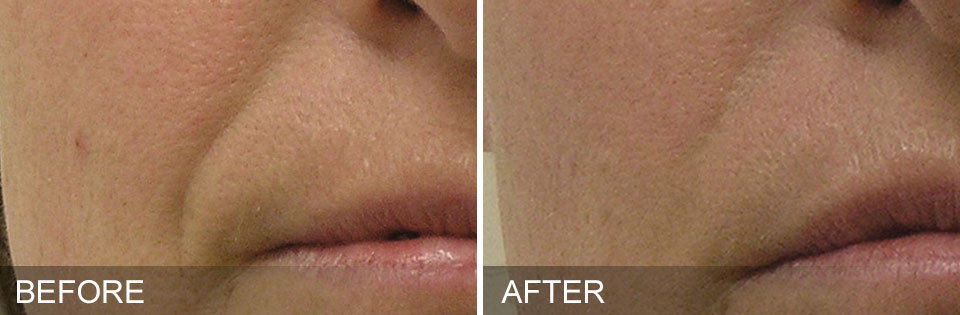 Before and After photos of using Hydrafacial for minimizing smile lines